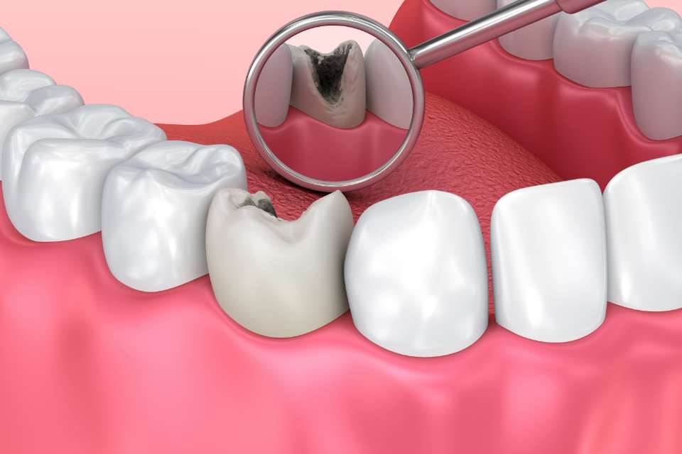 歯周病や初期のむし歯は痛みなく進行してしまうため