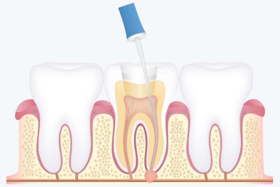 根管内から感染した歯髄を除去し洗浄・消毒